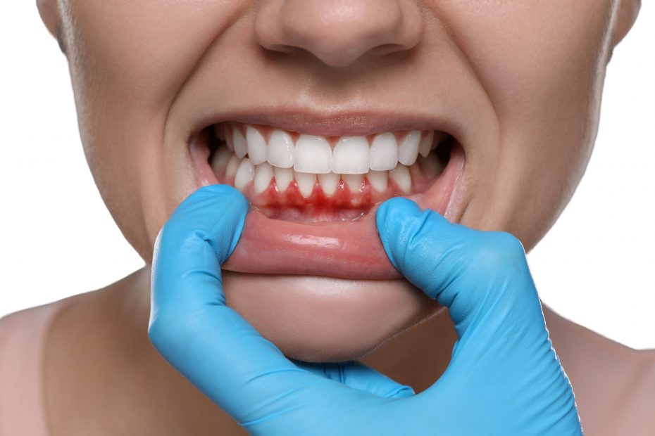 Tratamiento de periodontitis